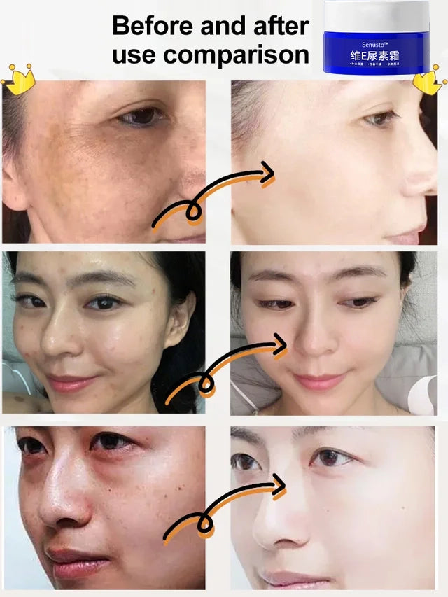【Old Spots and Yellow Spots Disappear】Spot Fading Urea Cream